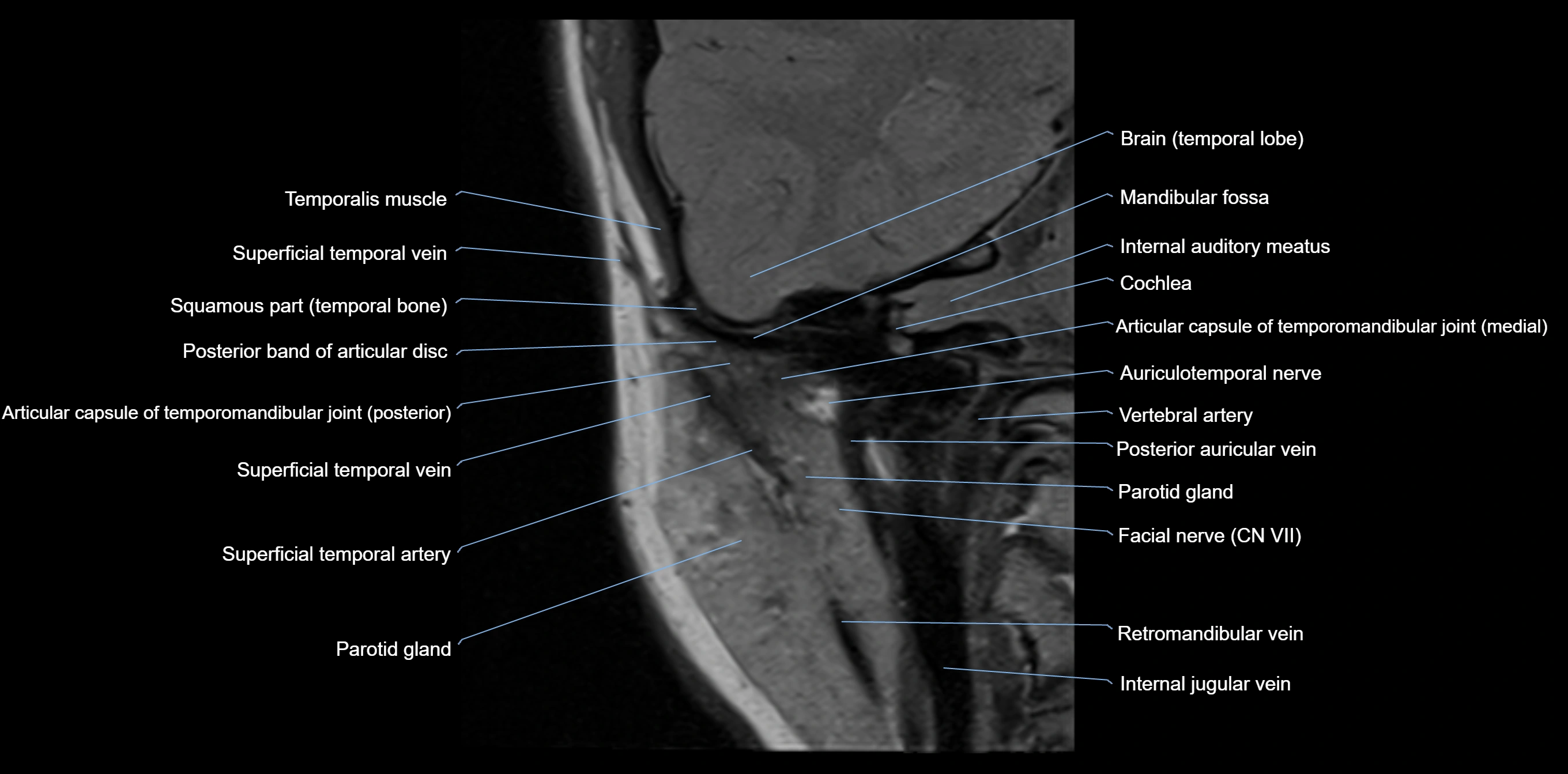 MRI TMJ coronal cross sectional 3T anatomy -img-00004-00010.webp